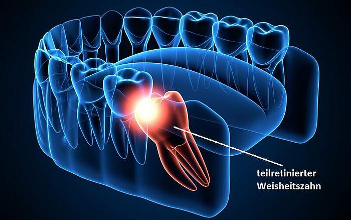 Weisheitszahn-OP -3D-Rendering eines Kieferröntgenbildes mit teilretiniertem Weisheitszahn.