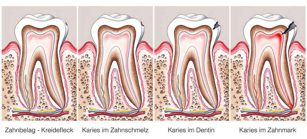Ratgeber Karies - Karies-Verlauf in 4 Stufen